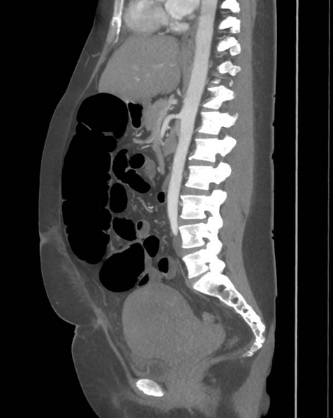 File:Colonic pseudo-obstruction (Radiopaedia 79752-92980 C 42).png