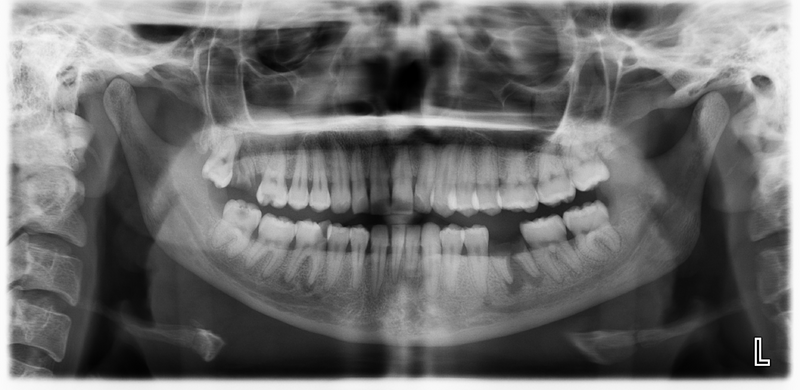 File:Dental abscess (Radiopaedia 43260).png