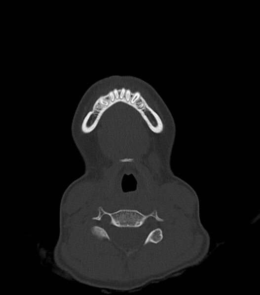 File:Nasoorbitoethmoid fracture (Radiopaedia 90044-107205 Axial bone window 19).jpg