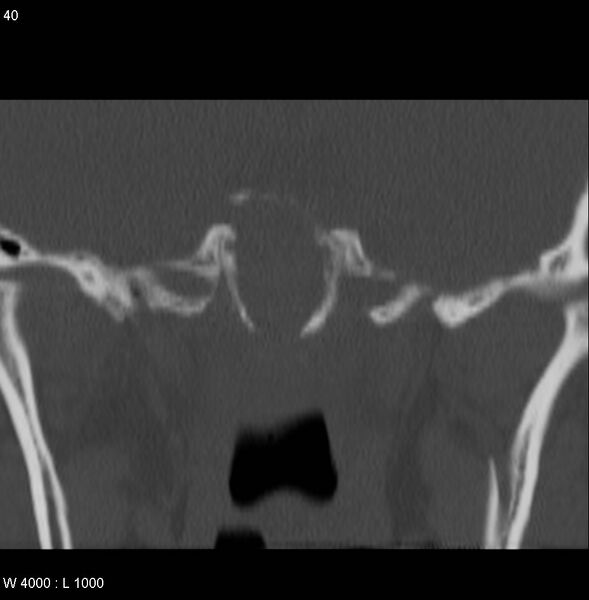 File:Nasopharyngeal carcinoma (recurrent) (Radiopaedia 5061-6903 Coronal bone window 13).jpg
