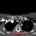 Nasopharyngeal carcinoma recurrence - skull base destruction (Radiopaedia 29107-29491 A 40).jpg