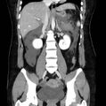Necrotizing pancreatitis (Radiopaedia 23001-23031 B 39).jpg