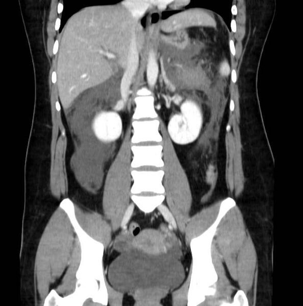 File:Necrotizing pancreatitis (Radiopaedia 23001-23031 B 39).jpg