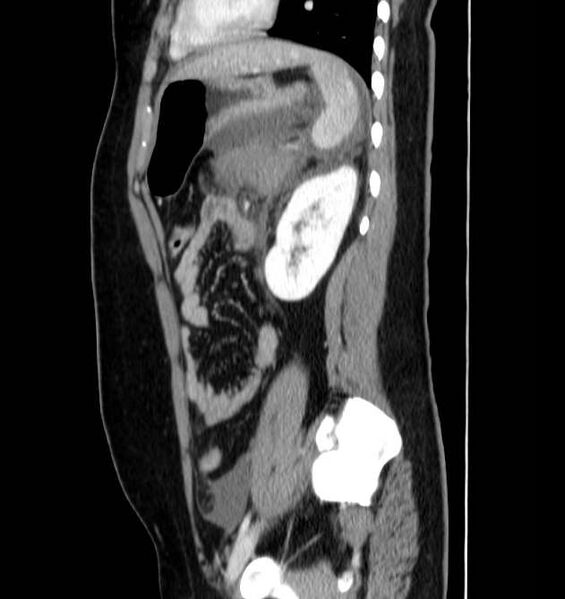 File:Necrotizing pancreatitis (Radiopaedia 23001-23031 C 58).jpg