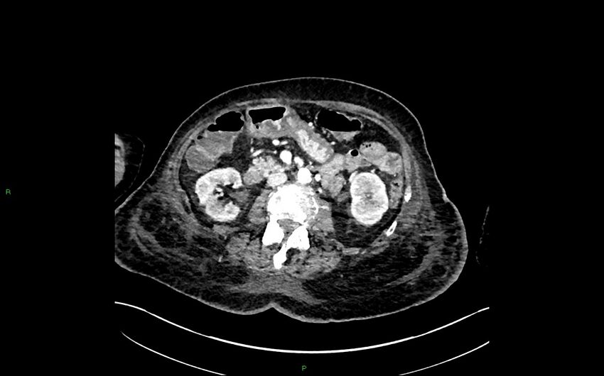Neo-terminal ileal stricture (Crohn disease) (Radiopaedia 33790-34948 A 194).jpg