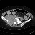 Nerve sheath tumor - malignant - sacrum (Radiopaedia 5219-6987 A 4).jpg