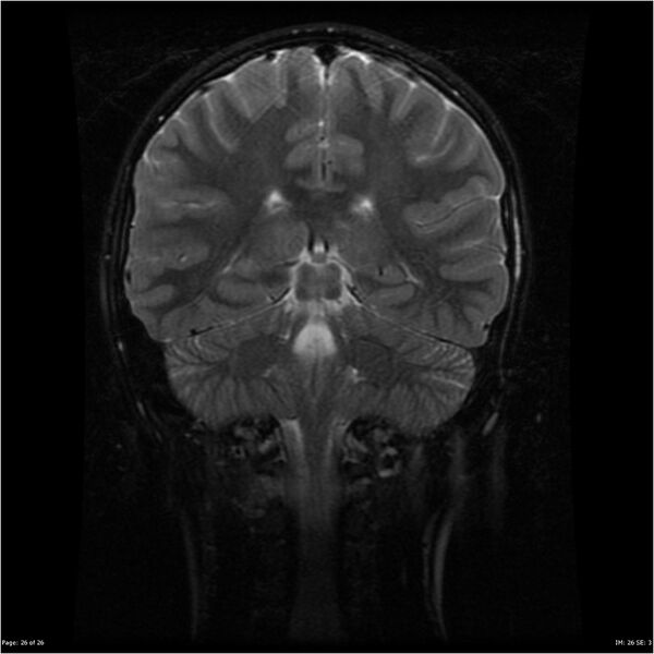 File:Neurofibromatosis type 1 (Radiopaedia 22541-22564 C 26).jpg