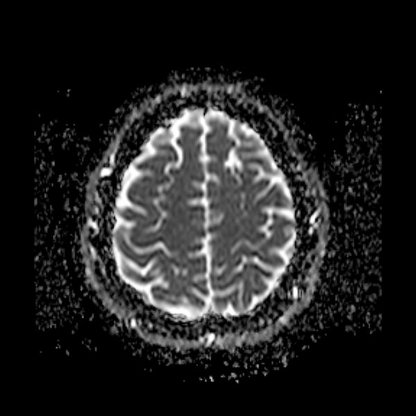 File:Neurofibromatosis type 2 (Radiopaedia 67470-76871 Axial ADC 19).jpg