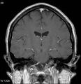 Neurosarcoidosis (Radiopaedia 10930-17204 Coronal T1 C+ 10).jpg