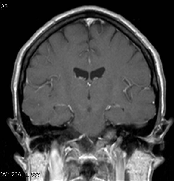 File:Neurosarcoidosis (Radiopaedia 10930-17204 Coronal T1 C+ 10).jpg