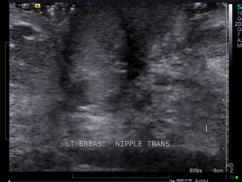 File:Nipple adenoma (Radiopaedia 32880-33856 Transverse 1).jpg