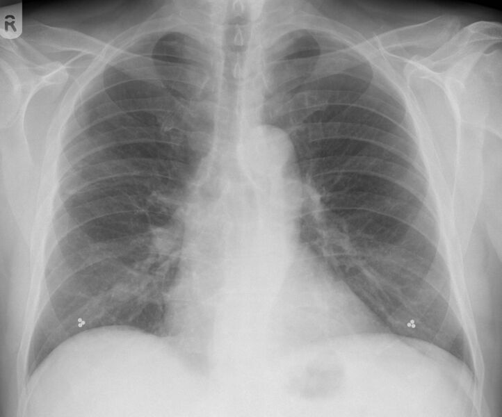 File:Nipple markers- solitary pulmonary nodule (Radiopaedia 19531-19570 B 1).jpg