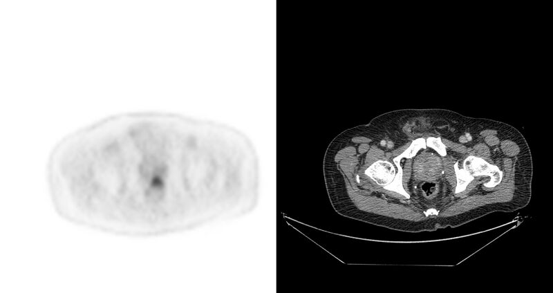 File:Non-Hodgkin lymphoma involving seminal vesicles with development of interstitial pneumonitis during Rituximab therapy (Radiopaedia 32703-33675 axial PET CT 7).jpg