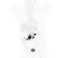Non-Hodgkin lymphoma involving seminal vesicles with development of interstitial pneumonitis during Rituximab therapy (Radiopaedia 32703-33677 Annotated PET 1).jpg