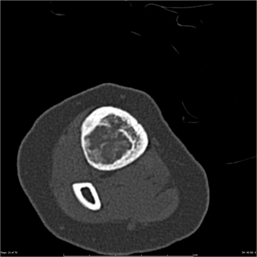 Non-ossifying fibroma (Radiopaedia 23651-23780 bone window 21).jpg