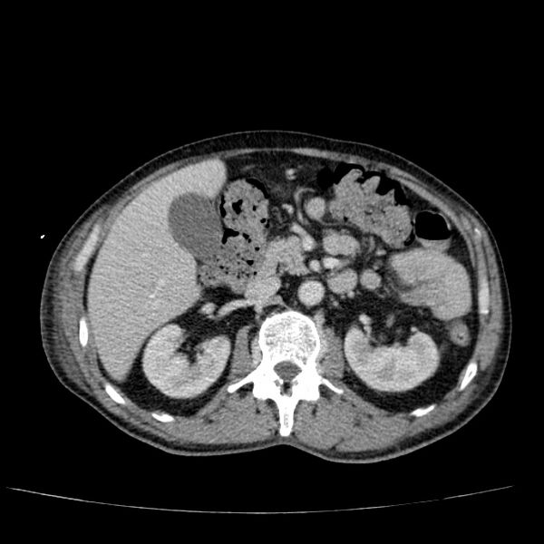 File:Non small-cell lung cancer (Radiopaedia 24467-24769 C+ delayed 71).jpg