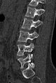 Normal CT lumbar spine (Radiopaedia 53981-60118 Sagittal bone window 65).jpg