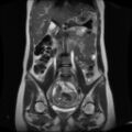 Normal MRI abdomen in pregnancy (Radiopaedia 88001-104541 Coronal T2 17).jpg