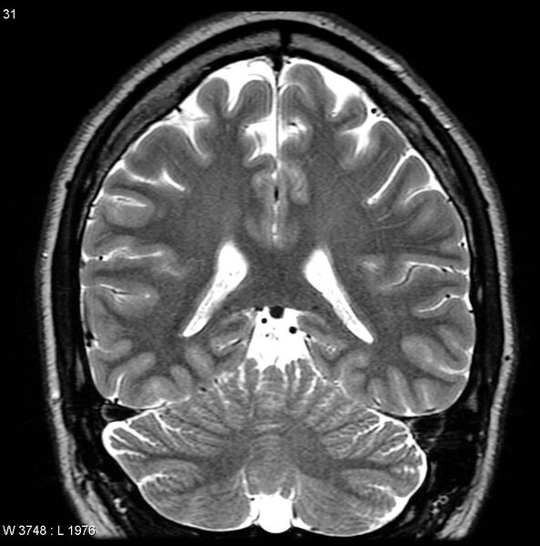 File:Normal coronal brain (Radiopaedia 6676-7910 Coronal T2 31).jpg