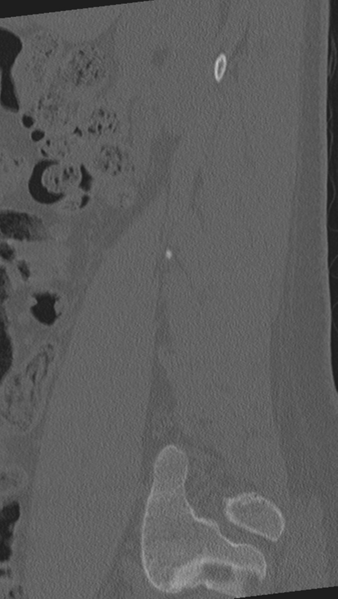 File:Normal lumbar spine CT (Radiopaedia 46533-50986 Sagittal bone window 83).png