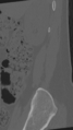 Normal lumbar spine CT (Radiopaedia 46533-50986 Sagittal bone window 97).png
