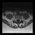 Normal spine MRI (Radiopaedia 77323-89408 Axial T1 21).jpg