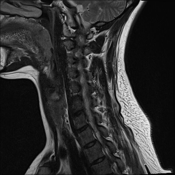 File:Normal trauma cervical spine MRI (Radiopaedia 32130-33071 Sagittal T2 11).jpg