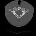 Normal trauma spine imaging (age 16) (Radiopaedia 45335-49358 Axial bone window 13).jpg