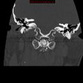 Occipital condyle fracture (Radiopaedia 18366-18208 Coronal bone window 6).jpg