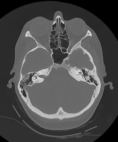 File:Occipital condyle fracture (Radiopaedia 61165-69056 Axial bone window 18).jpg