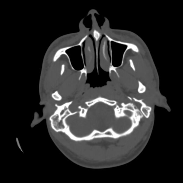File:Occipital spur - asymptomatic (Radiopaedia 87753-104201 Axial bone window 9).jpg