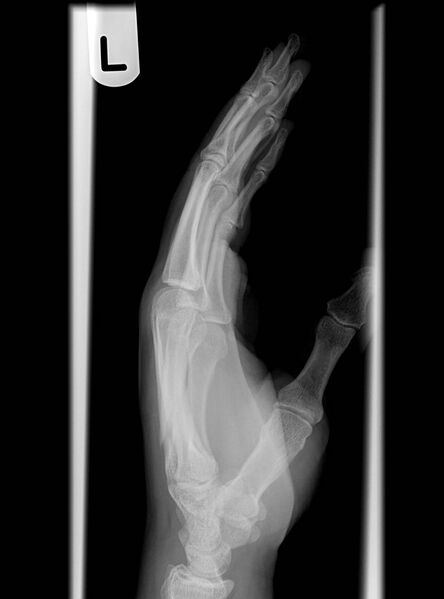 File:4th metacarpal fracture (Radiopaedia 7314-8223 Lateral 1).jpg
