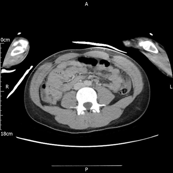 File:AAST grade IV kidney injury with CEUS follow-up (Radiopaedia 72353-82877 Axial C+ portal venous phase 40).jpg