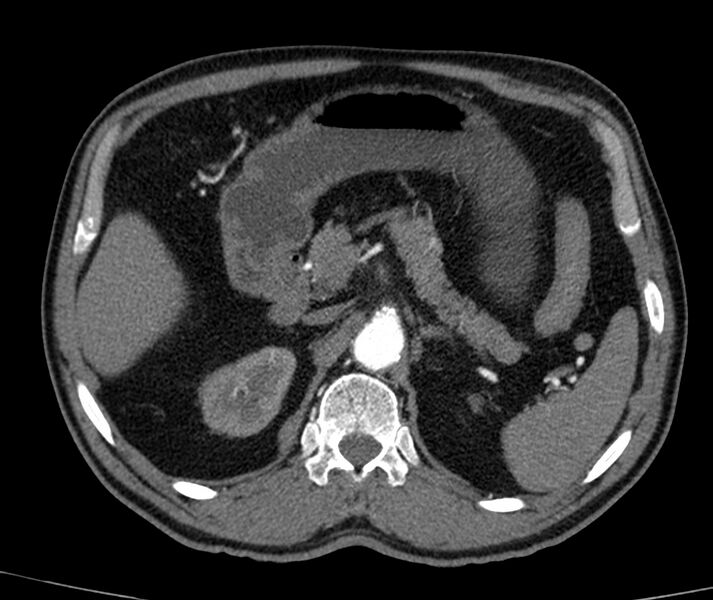 File:Abdominal aortic aneurysm (Radiopaedia 22421-22458 C+ arterial phase 19).jpg