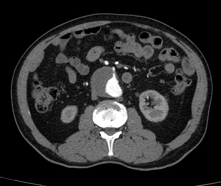 File:Abdominal aortic aneurysm (Radiopaedia 22421-22458 C+ arterial phase 40).jpg