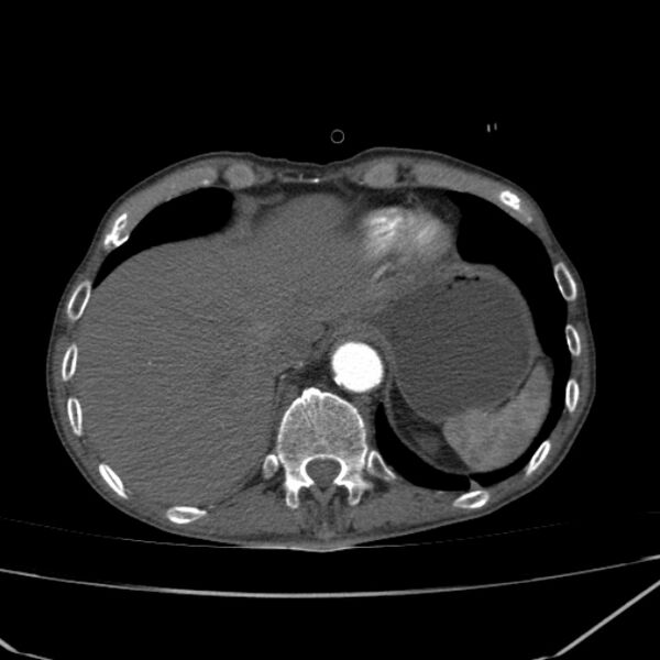 File:Abdominal aortic aneurysm (Radiopaedia 23703-23856 Axial C+ arterial phase 4).jpg