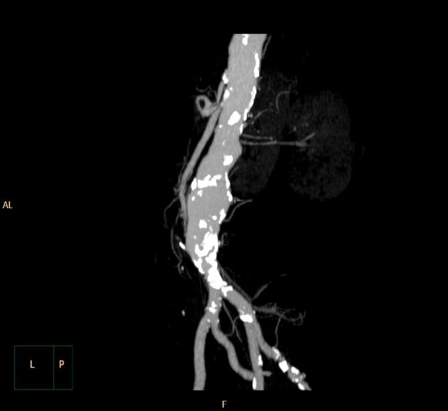 File:Abdominal aortic aneurysm (Radiopaedia 23703-23856 MIP 18).jpg