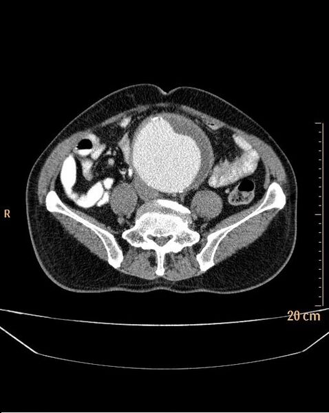 File:Abdominal aortic aneurysm (Radiopaedia 25985-26121 Axial C+ arterial phase 26).jpg