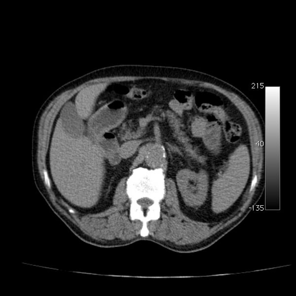 File:Abdominal aortic aneurysm (Radiopaedia 29248-29660 Axial non-contrast 21).jpg