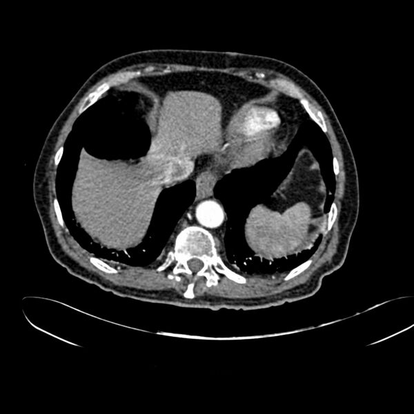 File:Abdominal aortic aneurysm (Radiopaedia 75131-86203 Axial C+ arterial phase 7).jpg