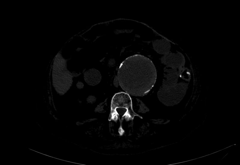 File:Abdominal aortic aneurysm - impending rupture (Radiopaedia 19233-19246 B 21).jpg