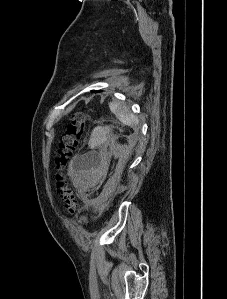 File:Abdominal aortic aneurysm rupture (Radiopaedia 54179-60362 Sagittal C+ arterial phase 41).jpg