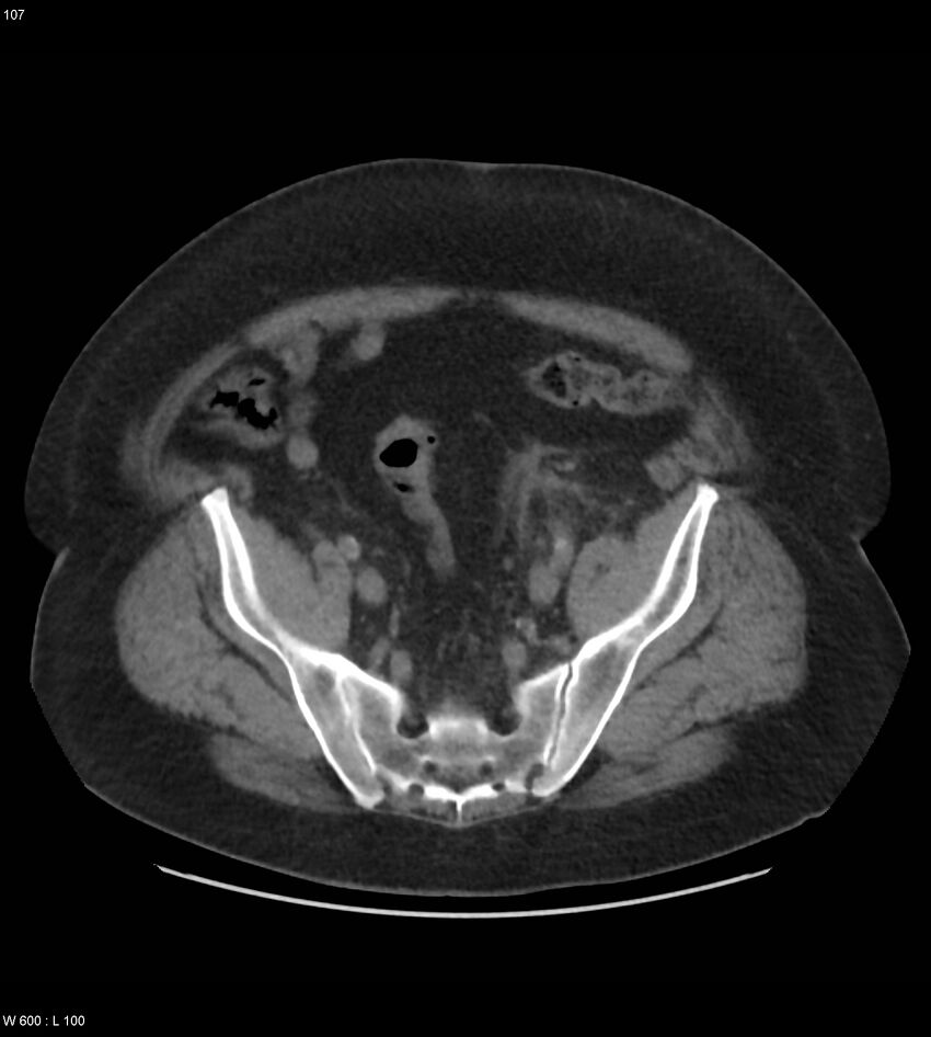 Abdominal aortic aneurysm with intramural hematoma then rupture (Radiopaedia 50278-55631 Axial non-contrast 103).jpg
