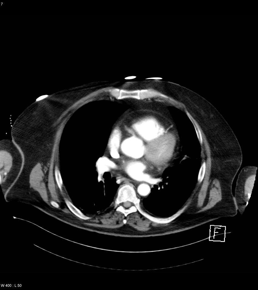 Abdominal aortic aneurysm with intramural hematoma then rupture (Radiopaedia 50278-55632 Axial C+ arterial phase 6).jpg