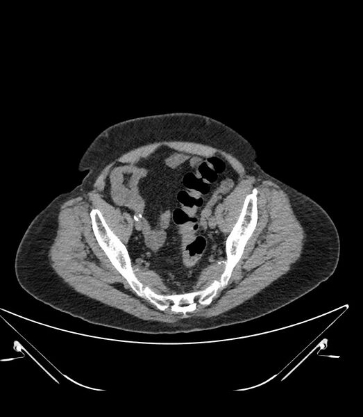 File:Abdominal aortic aneurysm with thrombus fissuration (Radiopaedia 46218-50618 Axial non-contrast 48).jpg