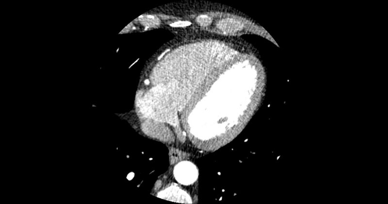 File:Aberrant left main coronary artery (ALMCA) arising from the right sinus with interarterial course (Radiopaedia 63251-71814 Axial C+ arterial phase 144).JPG