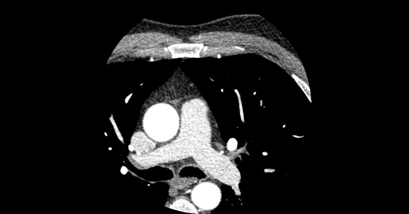 File:Aberrant left main coronary artery (ALMCA) arising from the right sinus with interarterial course (Radiopaedia 63251-71814 Axial C+ arterial phase 16).JPG