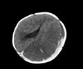 Abusive head trauma (Radiopaedia 70205-80252 Axial non-contrast 20).jpg