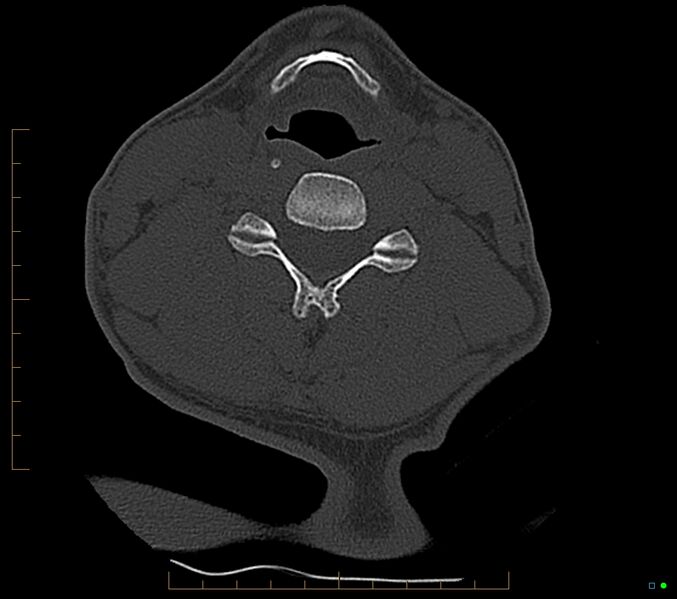 File:Accessory articulation of cervical transverse processes (Radiopaedia 82715-96933 Axial non-contrast 75).jpg