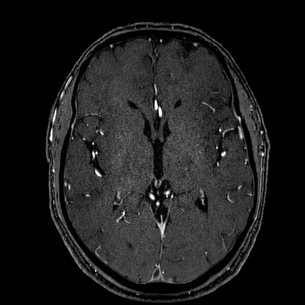 File:Accessory middle cerebral artery (Radiopaedia 73114-83828 Axial MRA 102).jpg